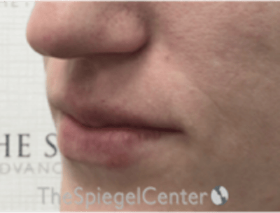 Lip Filler Before & After Gallery - Patient 543966 - Image 6