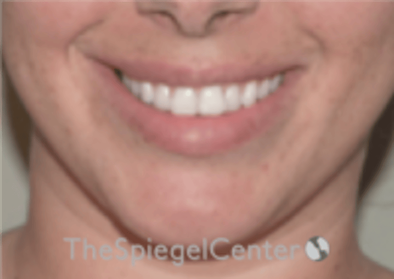 Lip Filler Before & After Gallery - Patient 340219 - Image 1