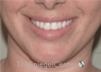 Lip Filler Before & After Gallery - Patient 340219 - Image 1