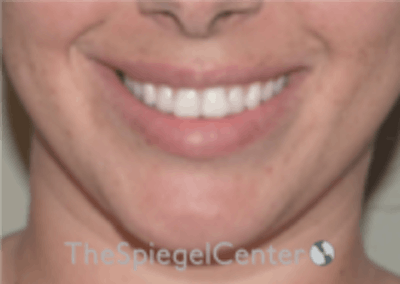 Lip Filler Before & After Gallery - Patient 340219 - Image 1