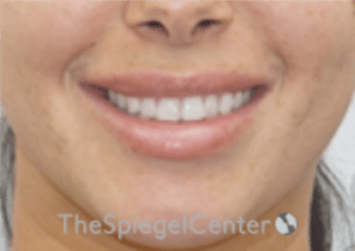 Lip Filler Before & After Gallery - Patient 340219 - Image 2
