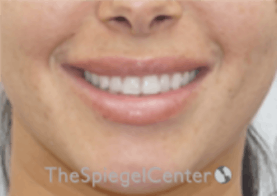 Lip Filler Before & After Gallery - Patient 340219 - Image 2