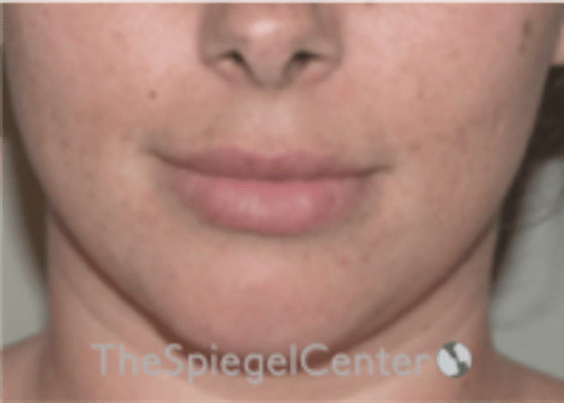 Lip Filler Before & After Gallery - Patient 340219 - Image 3