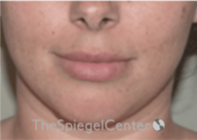 Lip Filler Before & After Gallery - Patient 340219 - Image 3