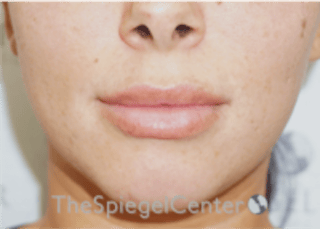 Lip Filler Before & After Gallery - Patient 340219 - Image 4