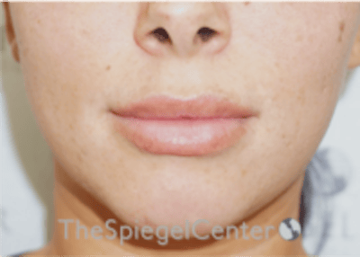 Lip Filler Before & After Gallery - Patient 340219 - Image 4