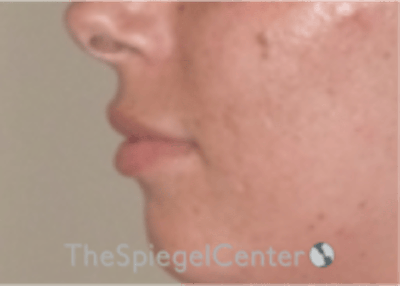 Lip Filler Before & After Gallery - Patient 340219 - Image 5