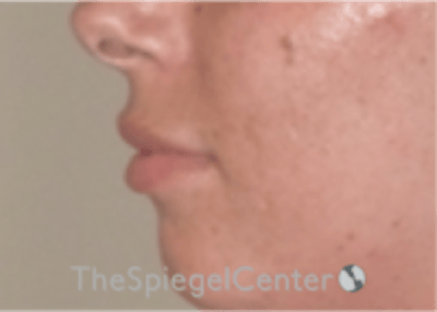 Lip Filler Before & After Gallery - Patient 340219 - Image 5