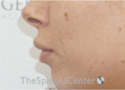Lip Filler Before & After Gallery - Patient 340219 - Image 6