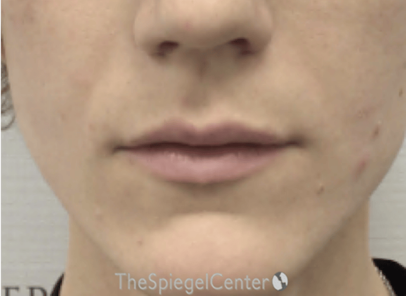 Lip Filler Before & After Gallery - Patient 244354 - Image 1