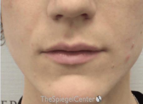 Lip Filler Before & After Gallery - Patient 244354 - Image 1