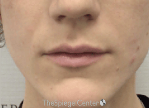 Lip Filler Before & After Gallery - Patient 244354 - Image 1