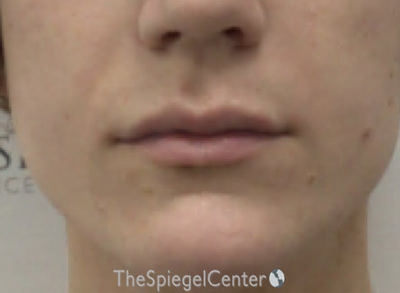 Lip Filler Before & After Gallery - Patient 244354 - Image 2