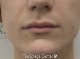 Lip Filler Before & After Gallery - Patient 244354 - Image 2