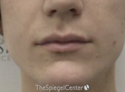 Lip Filler Before & After Gallery - Patient 244354 - Image 2