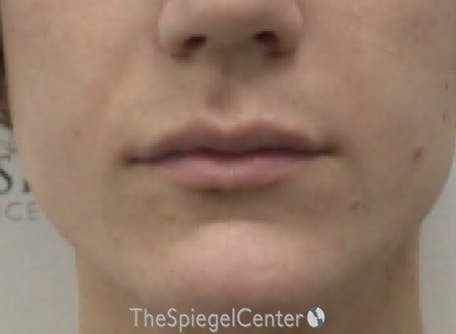 Lip Filler Before & After Gallery - Patient 244354 - Image 2