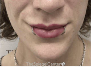 Lip Filler Before & After Gallery - Patient 244354 - Image 4