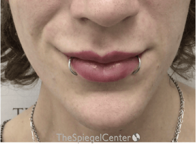 Lip Filler Before & After Gallery - Patient 244354 - Image 4