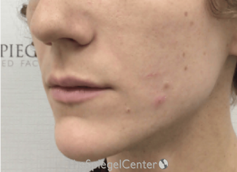 Lip Filler Before & After Gallery - Patient 244354 - Image 5