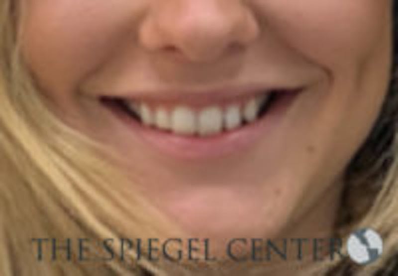 Lip Filler Before & After Gallery - Patient 764214 - Image 1