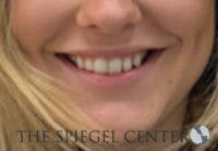 Lip Filler Before & After Gallery - Patient 764214 - Image 1