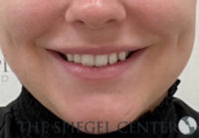 Lip Filler Before & After Gallery - Patient 764214 - Image 2