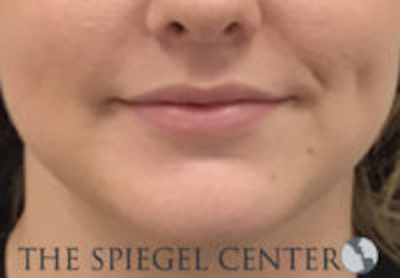 Lip Filler Before & After Gallery - Patient 764214 - Image 3