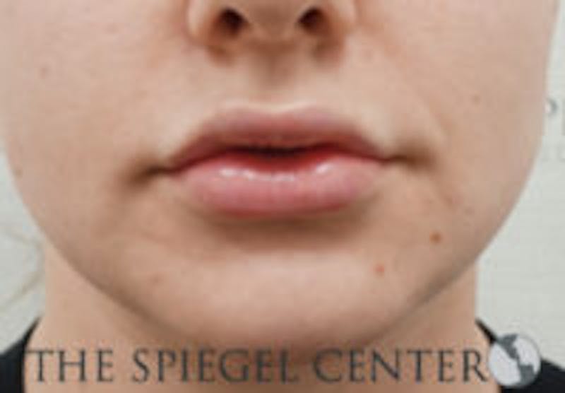Lip Filler Before & After Gallery - Patient 764214 - Image 4