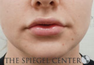 Lip Filler Before & After Gallery - Patient 764214 - Image 4