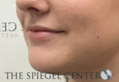 Lip Filler Before & After Gallery - Patient 764214 - Image 5