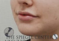 Lip Filler Before & After Gallery - Patient 764214 - Image 6