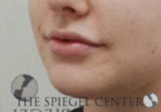 Lip Filler Before & After Gallery - Patient 764214 - Image 6