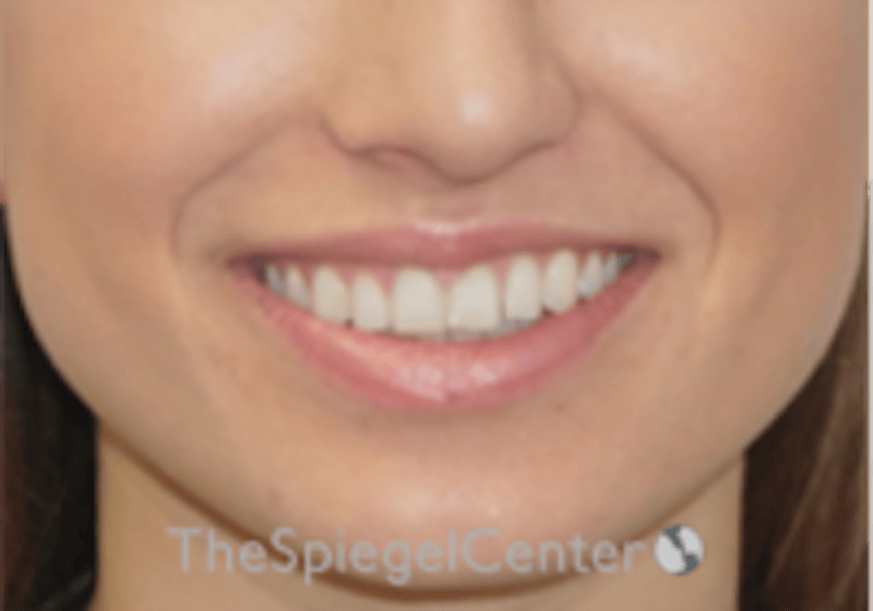 Lip Filler Before & After Gallery - Patient 332182 - Image 1