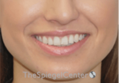 Lip Filler Before & After Gallery - Patient 332182 - Image 1