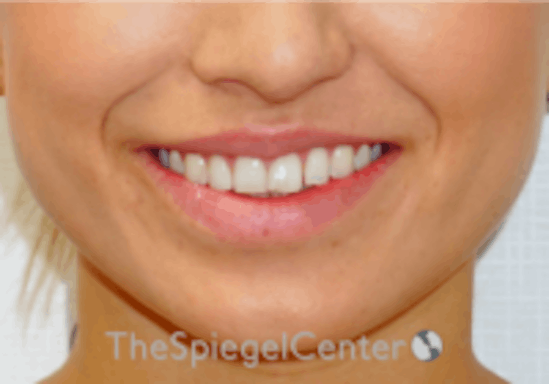 Lip Filler Before & After Gallery - Patient 332182 - Image 2