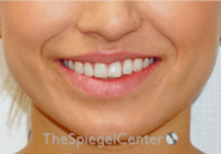Lip Filler Before & After Gallery - Patient 332182 - Image 2