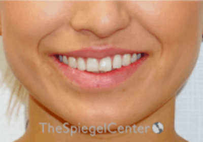 Lip Filler Before & After Gallery - Patient 332182 - Image 2