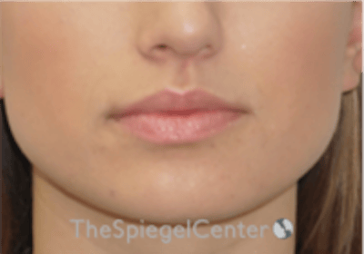 Lip Filler Before & After Gallery - Patient 332182 - Image 3