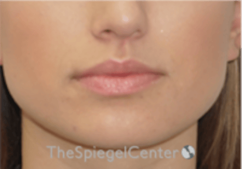 Lip Filler Before & After Gallery - Patient 332182 - Image 3