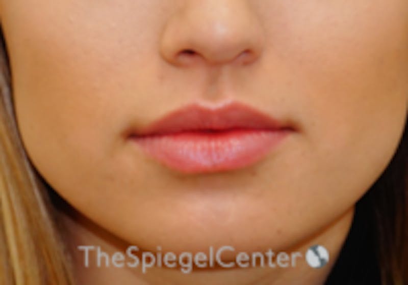 Lip Filler Before & After Gallery - Patient 332182 - Image 4