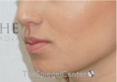 Lip Filler Before & After Gallery - Patient 332182 - Image 5
