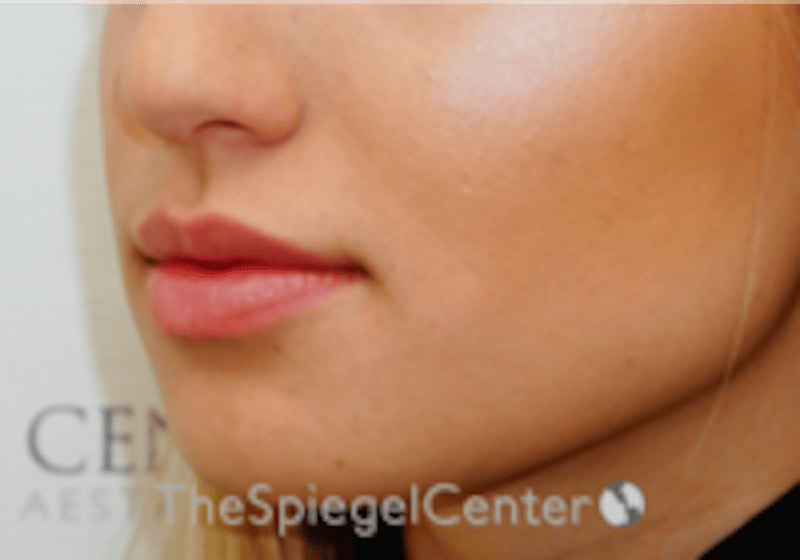 Lip Filler Before & After Gallery - Patient 332182 - Image 6
