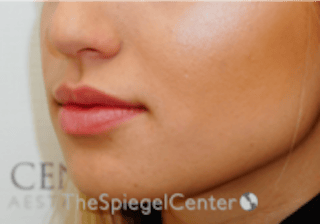 Lip Filler Before & After Gallery - Patient 332182 - Image 6