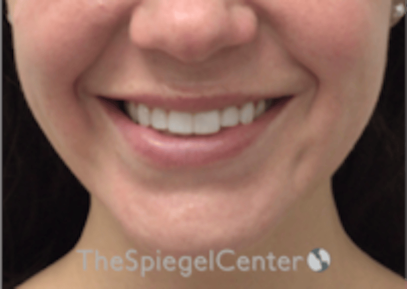 Lip Filler Before & After Gallery - Patient 333340 - Image 1