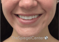 Lip Filler Before & After Gallery - Patient 333340 - Image 1