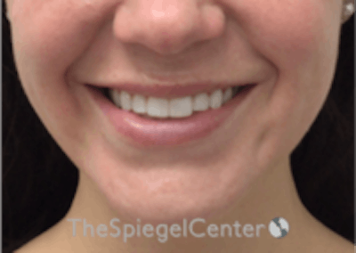 Lip Filler Before & After Gallery - Patient 333340 - Image 1