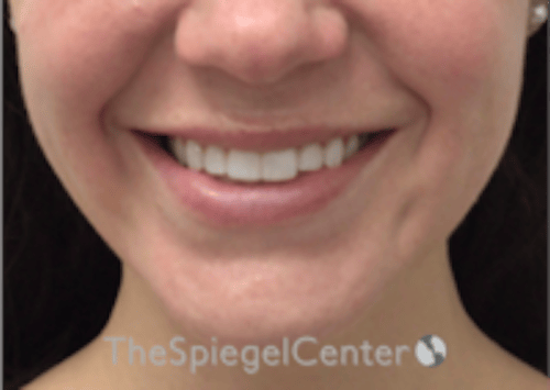 Lip Filler Before & After Gallery - Patient 333340 - Image 1