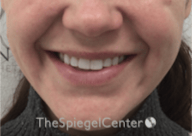 Lip Filler Before & After Gallery - Patient 333340 - Image 2