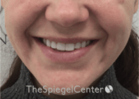 Lip Filler Before & After Gallery - Patient 333340 - Image 2