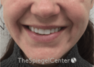 Lip Filler Before & After Gallery - Patient 333340 - Image 2